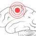 Ce este accidentul vascular cerebral (AVC)? 12 accidentul vascular cerebral