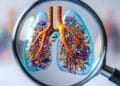 Boala pulmonară obstructivă cronică: afecțiunea tăcută 9 Boala pulmonară obstructivă cronică: afecțiunea tăcută