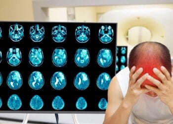 Cum recunoaștem semnele unui AVC